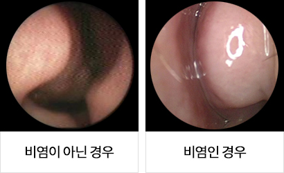 비염이 아닌 경우 와 비염인 경우