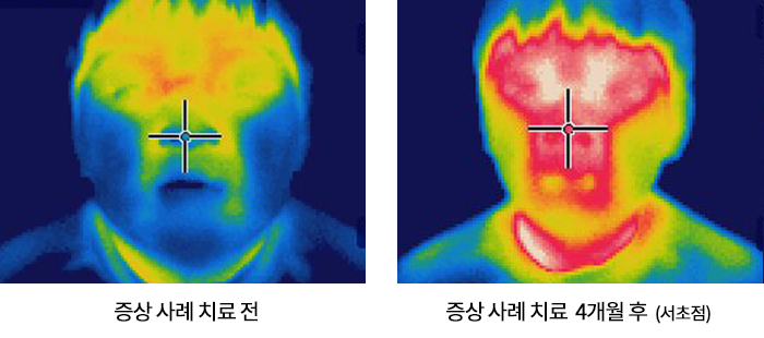 비염 치료사례